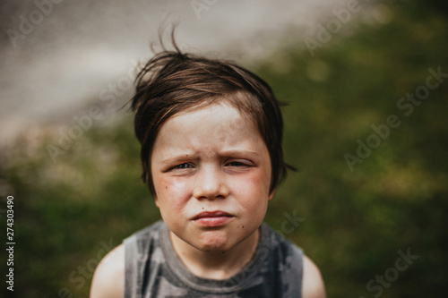 an unhappy boy has a bug bite on his eye