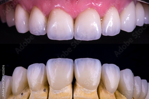 dental veneers and crowns photo