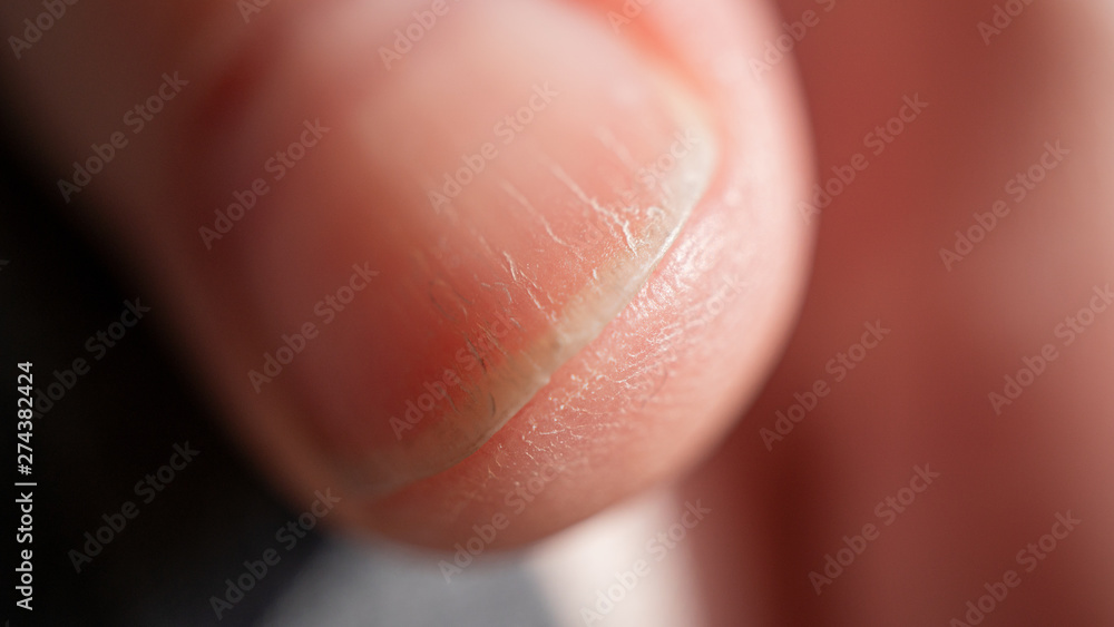Fingernagel Fingernagel