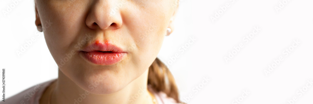 Part of a young woman face with red bubbles of virus herpes on lips Medicine, treatment. Long horizontal banner with copy space Selective focus Close up
