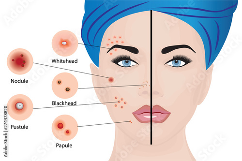 Acne types on a woman face 