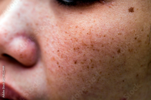 Woman 's problematic skin , acne scars ,oily skin and pore, dark spots and blackhead and whitehead on the face photo