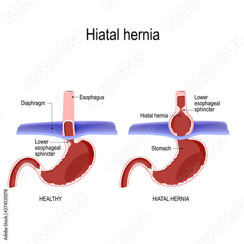 Hiatal hernia. Vector diagram of Normal anatomy and sliding hiatal hernia. photo