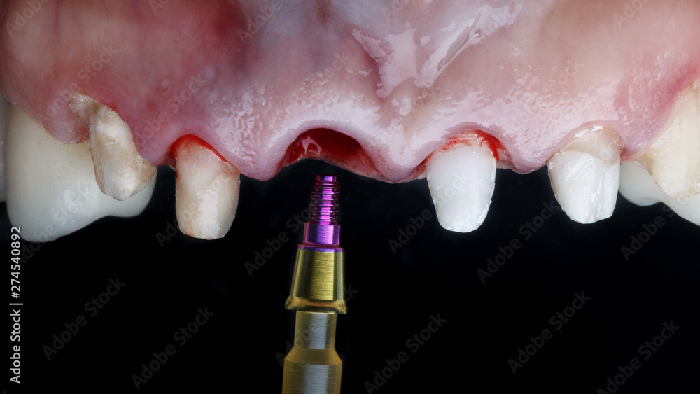 Fototapeta premium special surgical abutment after implantation of the front tooth on a black background