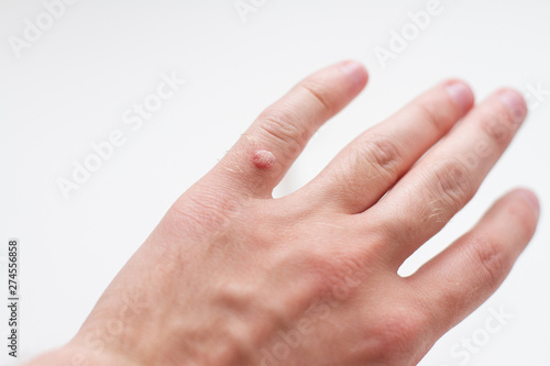 wart on a finger on a white background photo
