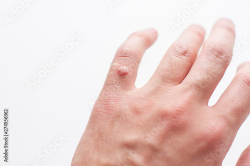 wart on finger hand