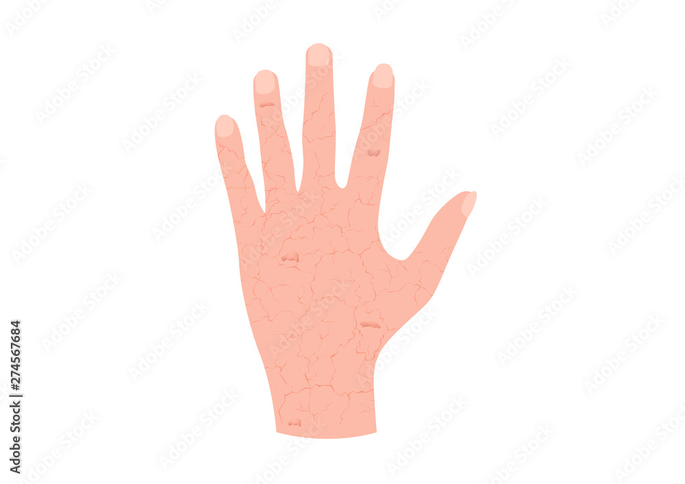 hand and dry skin vector / aging hand and dry skin vector / aging