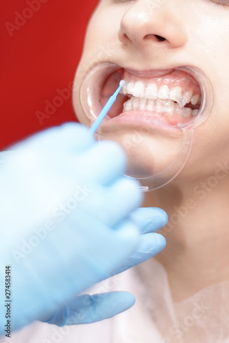 teeth whitening. preparation, the doctor applies the gel with a cotton swab