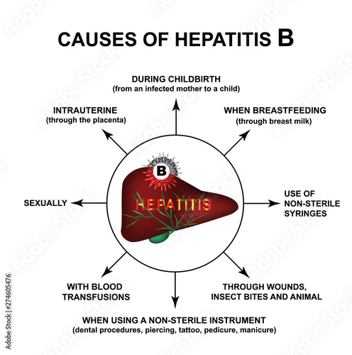 Causes of Hepatitis B. World Hepatitis Day. Infographics. Vector illustration on isolated background.