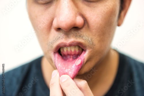 Pained aphtha ulcer mouth from accident photo