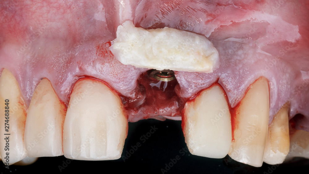 soft tissue flap for volume and restoration of the gum esthetics