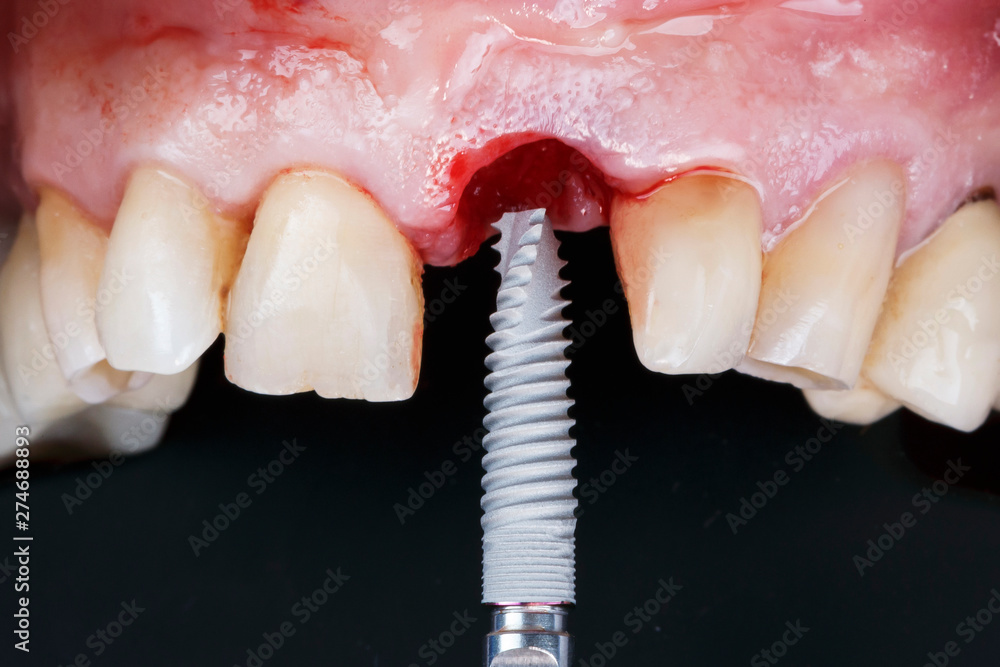 high-quality dental implant on the background of the patient's mouth before implantation