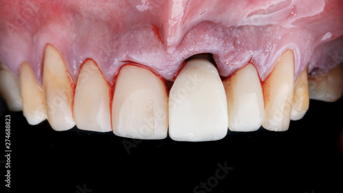 replacement of the front tooth on the crown and gum to add soft tissue for the volume and restore the esthetics