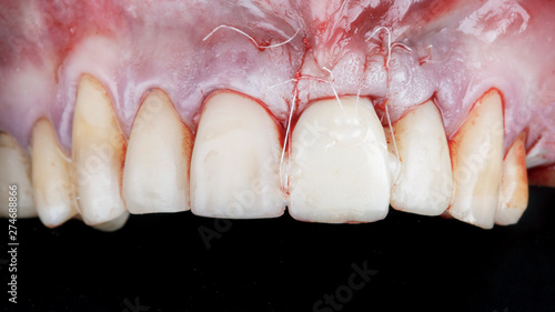 establish the crown of the front tooth and the sutured gum to restore