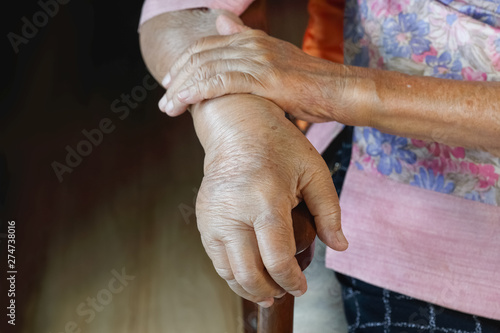 Fotografie Elderly swollen hand or edema hand