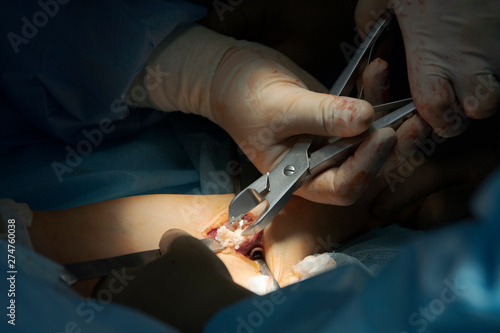 Surgical Nippers Closeup