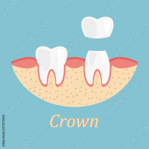 Teeth procedure of crown restoration. Process stomatology prosthesis