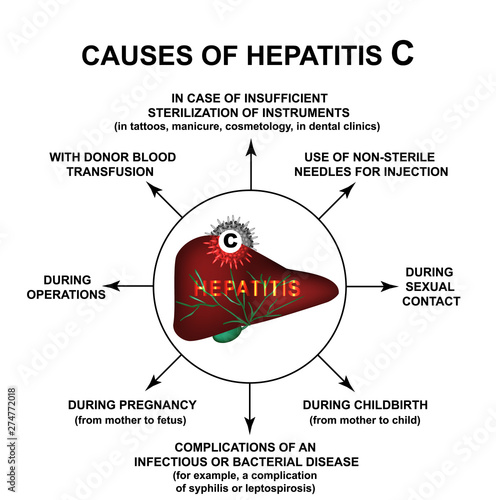 Causes of Hepatitis C. World Hepatitis Day. Infographics. Vector illustration on isolated background.