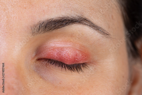 Macro of a woman's eye with swollen and inflamed eyelid, symptoms of blepharitis