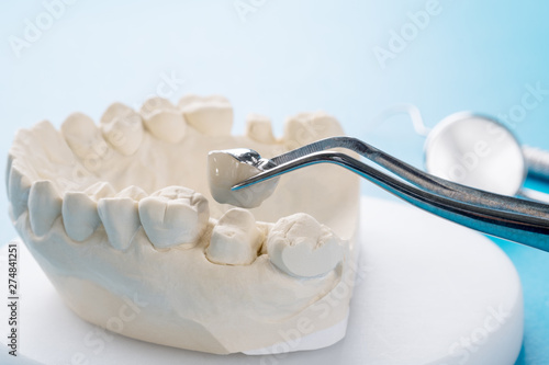 Close up Implan model tooth support fix bridge implan and crown.