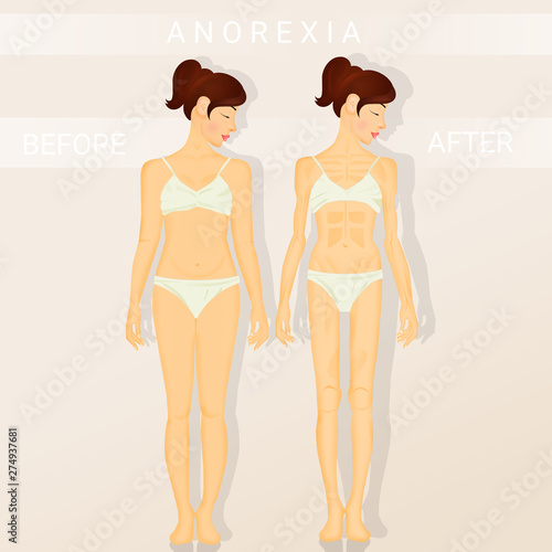 illustration of before and after anorexia