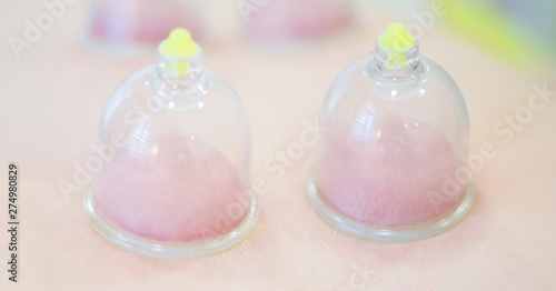 Hijama - the treatment of bloodletting. Attached vacuum cup.