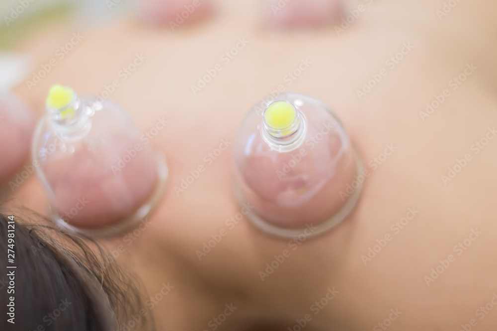 Naklejka premium Hijama - the treatment of bloodletting. Attached vacuum cup.