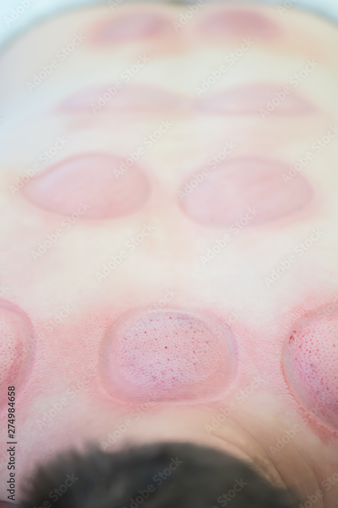 Hijama - the treatment of bloodletting. Scars at the end of process. Hijama - the treatment of bloodletting. Scars at the end of process.