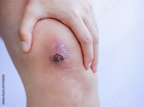 Scar and scab (eschar) on asian female knee photo