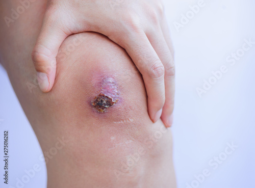 Scar and scab (eschar) on asian female knee