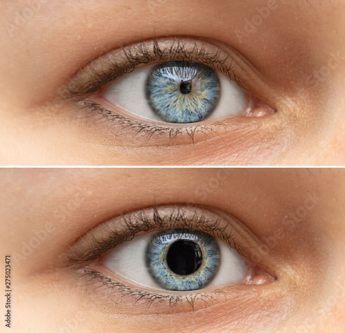 A closeup view on the blue eyes of a pretty young woman. Collage comparing the black pupil, one image shows an enlarged pupil and one shows a reduced pupil. Pupillary light reflex in humans.