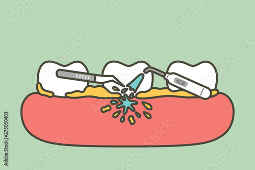 teeth scaling, dental plaque removal for cleaning - tooth cartoon vector flat style