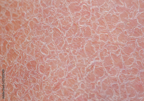 Photography background of unhealthy skin texture close-up covered with small and large crack