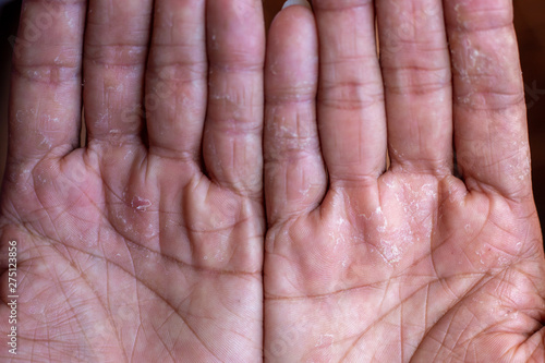 Fingers Skin peeling due to allergic reaction