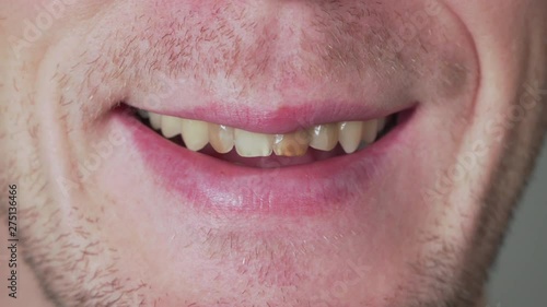 Man smiles and bad teeth reveal