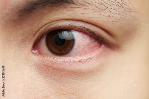 Bloodshot sick eyes close up