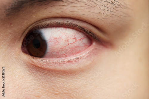 close up of Bloodshot sick eye