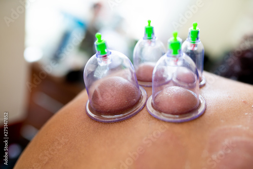 hijama cupping thrapy on women