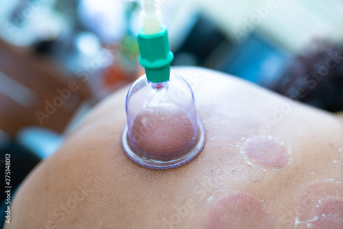 hijama cupping thrapy on women photo