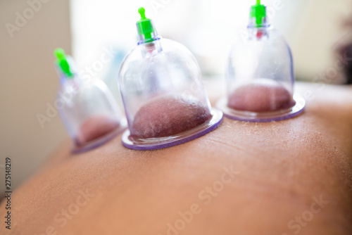 Cuadro en lienzo hijama cupping thrapy on women