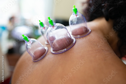 hijama cupping thrapy on women