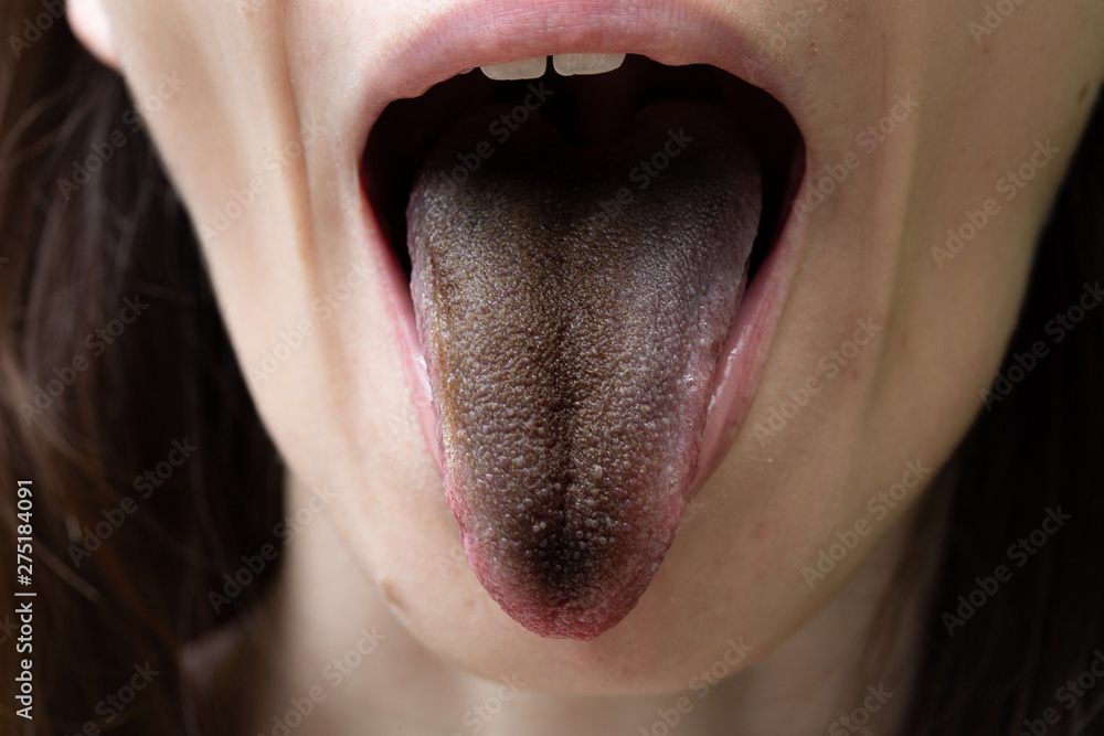 A closeup view of a girl with black hairy tongue (enterobacter cloacae). A common symptom of a bacterial infection in the mouth. - obrazy, fototapety, plakaty 
