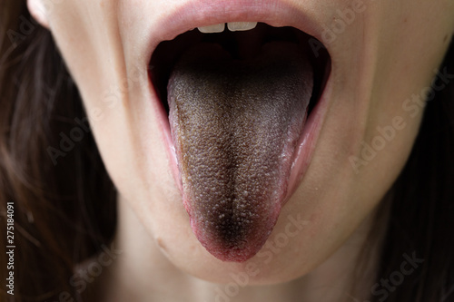 Fototapeta A closeup view of a girl with black hairy tongue (enterobacter cloacae)