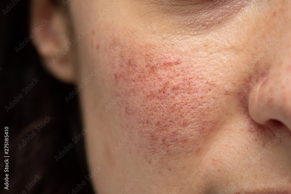 A closeup view on the face of a Caucasian girl with small superficial