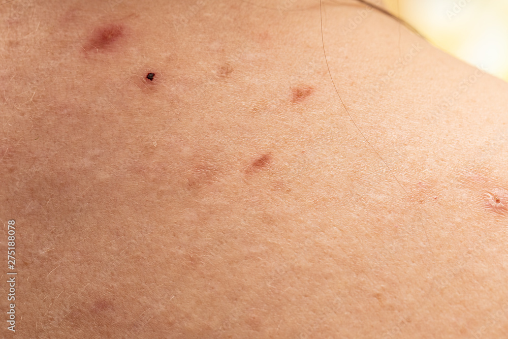 A close-up view of insect bites on human skin, towards the upper back and shoulders. Scabbed wounds similar to those of tick bites.