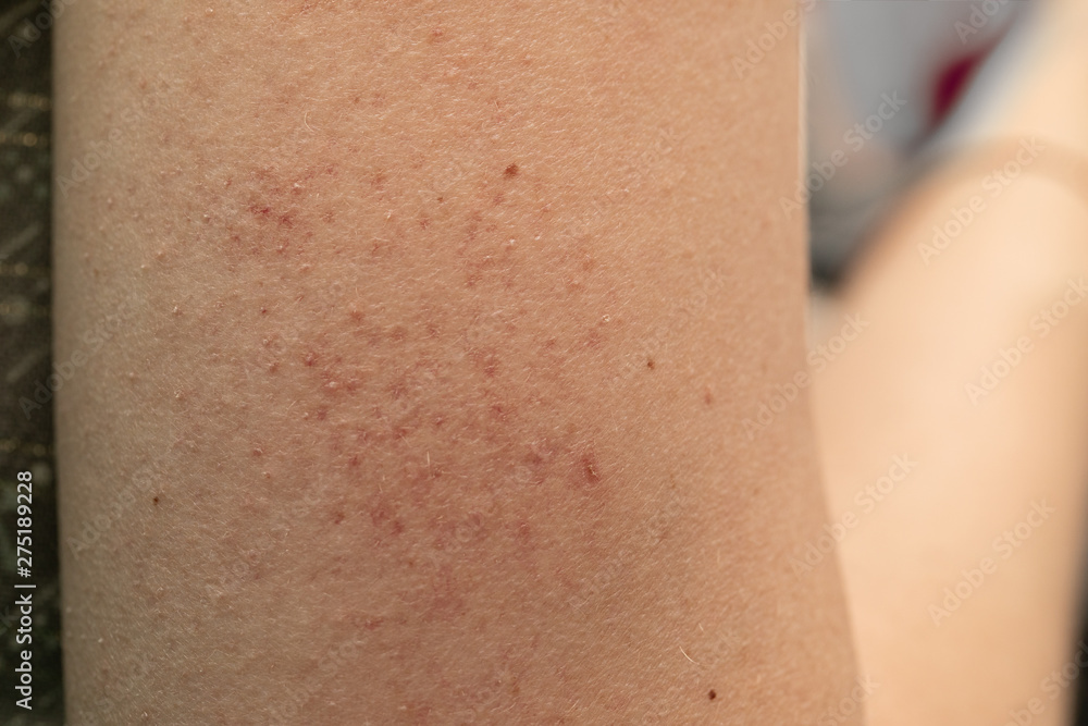 A closeup view of red and blotchy contact dermatitis on the arm of a young Caucasian woman with sensitive skin. A closeup view of red and blotchy contact dermatitis on the arm of a young Caucasian woman with sensitive skin.