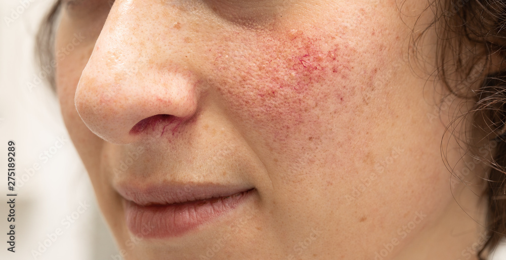 Fototapeta premium A closeup view on the face of a young woman suffering with rosacea on her cheeks and beneath her nose. Red blotches and prominent blood vessels are seen in detail.