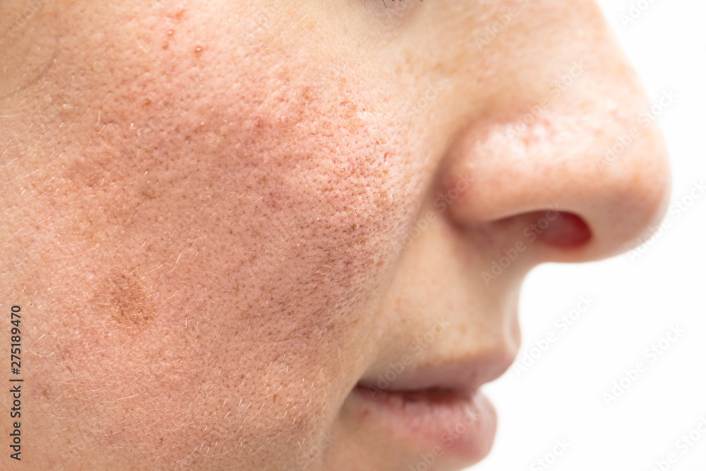 A side and profile view on the cheek and nose of a young Caucasian woman. Red and blushed after having laser surgery to remove rosacea symptoms. A side and profile view on the cheek and nose of a young Caucasian woman. Red and blushed after having laser surgery to remove rosacea symptoms.