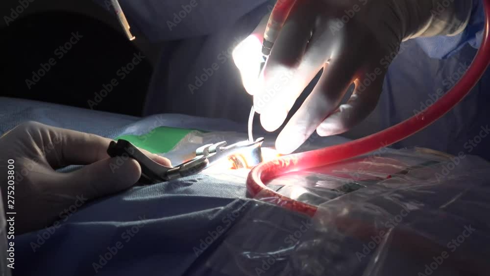 Stockvideon Spinal disc herniation is an injury to the cushioning and