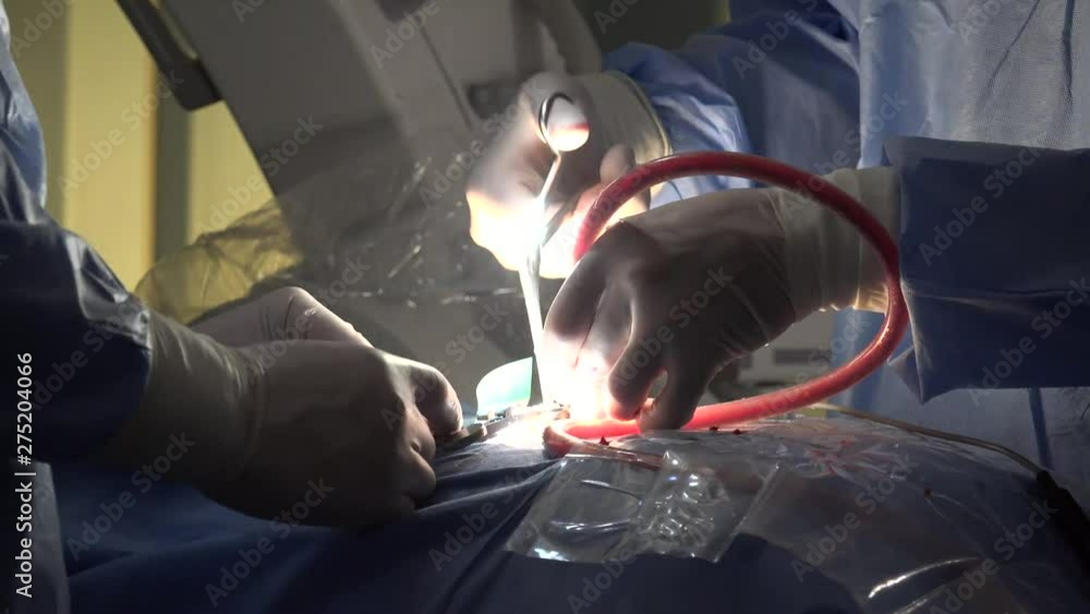 Spinal disc herniation is an injury to the cushioning and connective